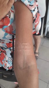 Fotografía de primer plano de una cicatriz queloidal elevada y texturizada en el bíceps superior del brazo de un cliente, antes de comenzar el proceso de cobertura en Trip n' Tattoo.